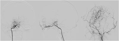 The Potential Mechanism Behind Native and Therapeutic Collaterals in Moyamoya